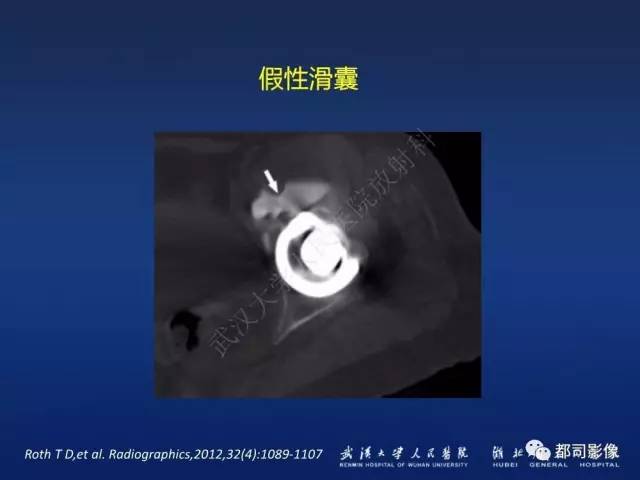 【PPT】髋关节置换术后影像学评价