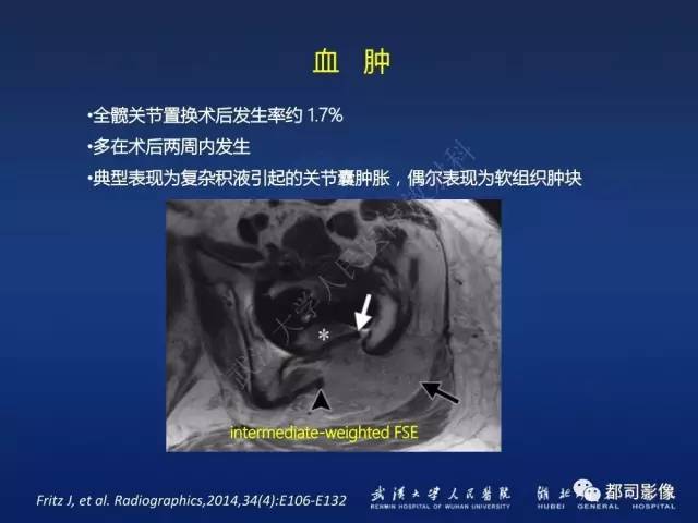 【PPT】髋关节置换术后影像学评价