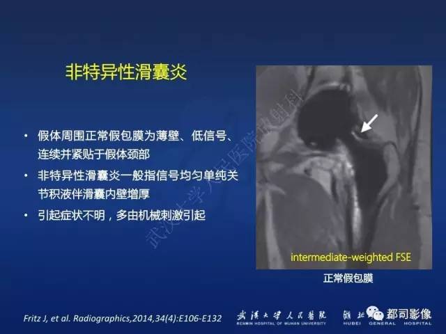 【PPT】髋关节置换术后影像学评价