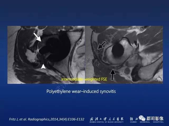 【PPT】髋关节置换术后影像学评价