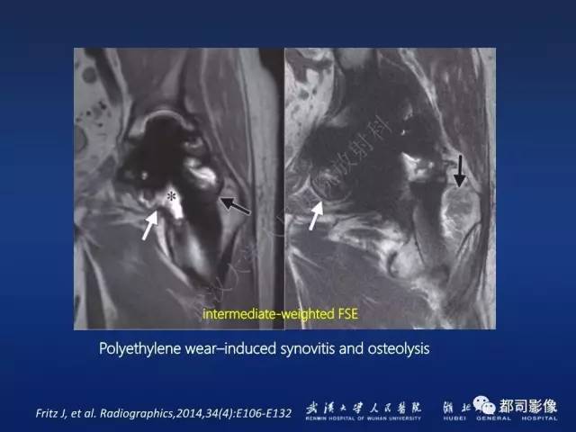 【PPT】髋关节置换术后影像学评价