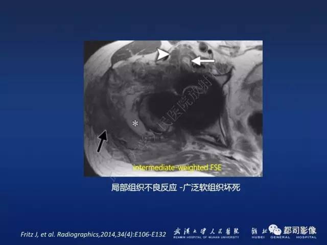【PPT】髋关节置换术后影像学评价