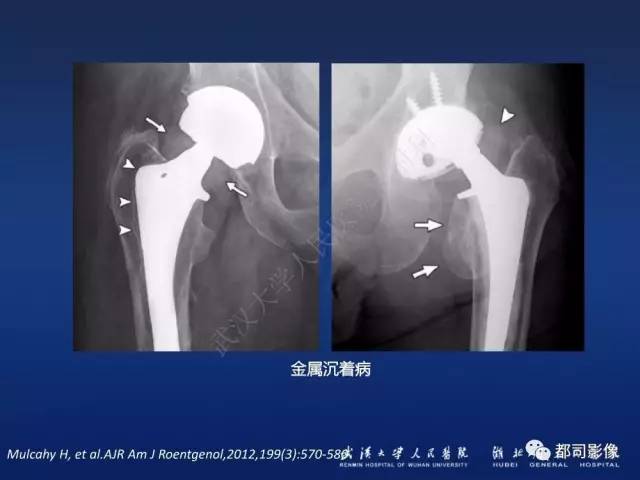 【PPT】髋关节置换术后影像学评价