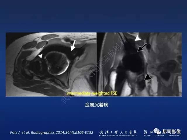 【PPT】髋关节置换术后影像学评价