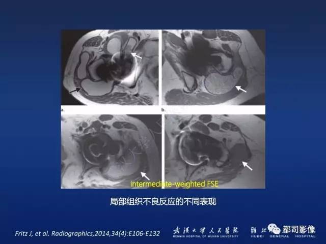 【PPT】髋关节置换术后影像学评价