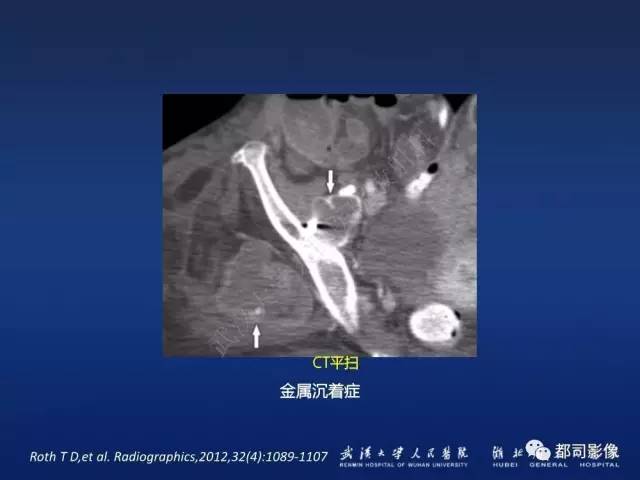 【PPT】髋关节置换术后影像学评价