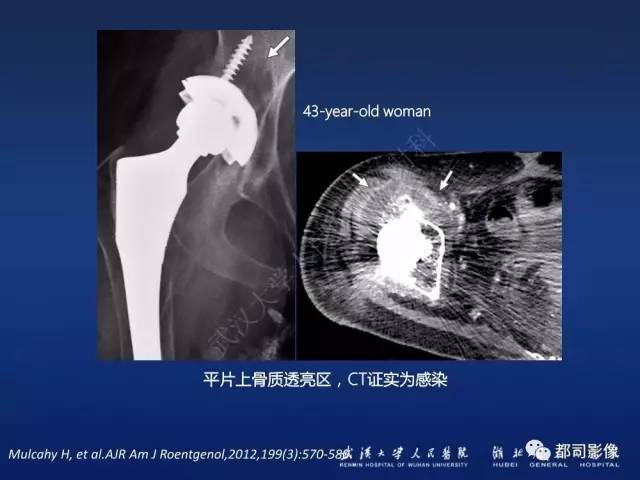 【PPT】髋关节置换术后影像学评价