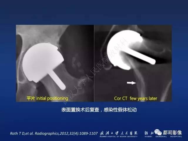 【PPT】髋关节置换术后影像学评价