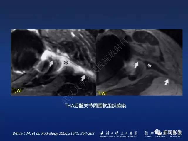 【PPT】髋关节置换术后影像学评价
