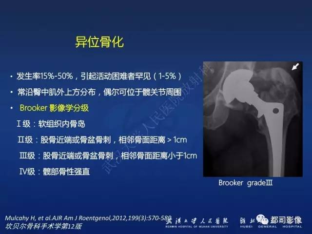 【PPT】髋关节置换术后影像学评价