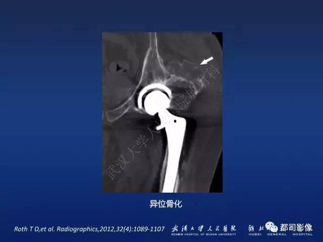 【PPT】髋关节置换术后影像学评价