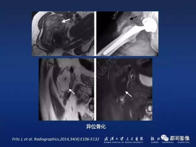 【PPT】髋关节置换术后影像学评价