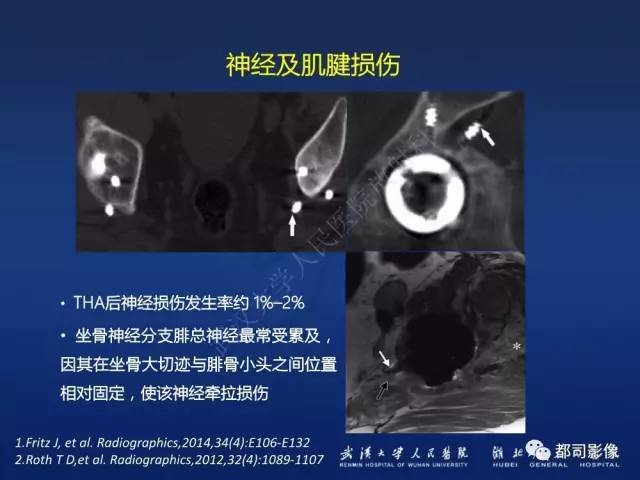 【PPT】髋关节置换术后影像学评价