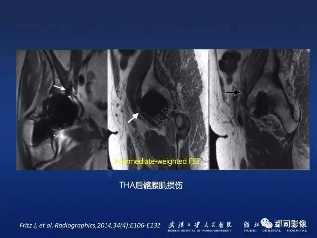 【PPT】髋关节置换术后影像学评价
