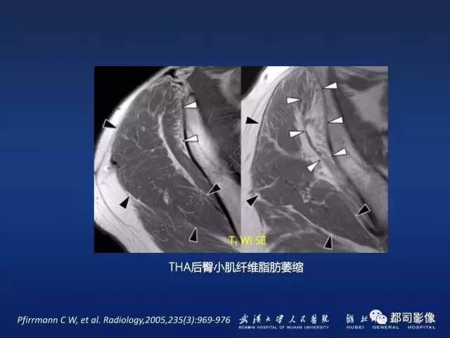 【PPT】髋关节置换术后影像学评价