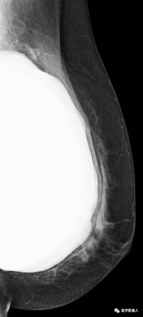 乳腺单腔硅胶假体破裂多模态影像学评估【RG精选】 乳腺单腔硅胶假体破裂多模态影像学评估【RG精选】