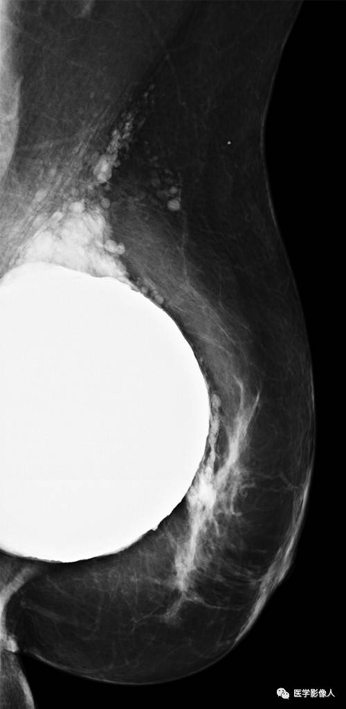 乳腺单腔硅胶假体破裂多模态影像学评估【RG精选】 乳腺单腔硅胶假体破裂多模态影像学评估【RG精选】