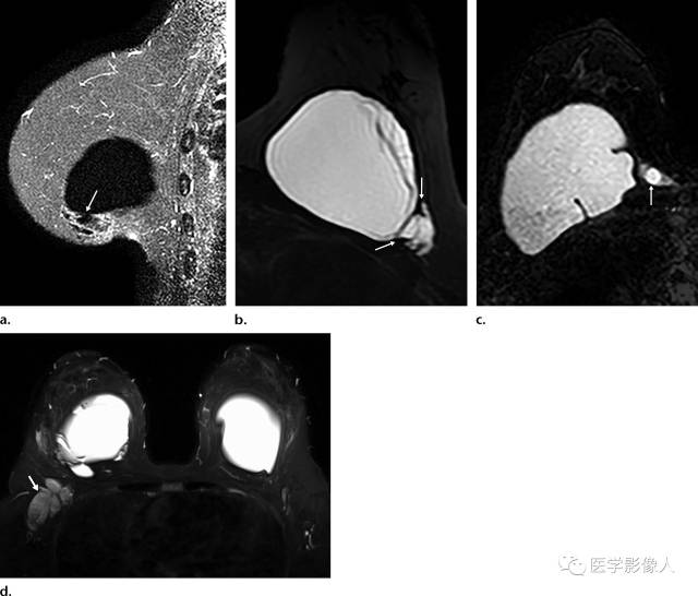 乳腺单腔硅胶假体破裂多模态影像学评估【RG精选】 乳腺单腔硅胶假体破裂多模态影像学评估【RG精选】