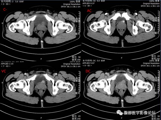 【病例】膀胱副神经节瘤1例CT影像表现