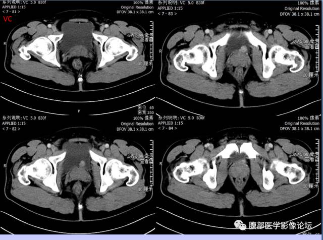 【病例】膀胱副神经节瘤1例CT影像表现