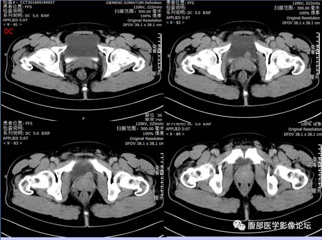 【病例】膀胱副神经节瘤1例CT影像表现