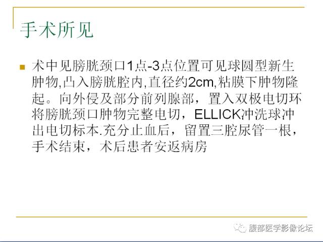 【病例】膀胱副神经节瘤1例CT影像表现