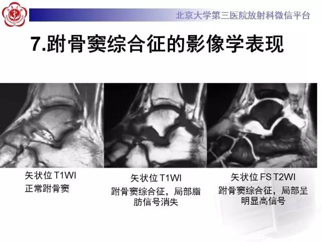 【病例】跗骨窦综合征1例MR影像诊断