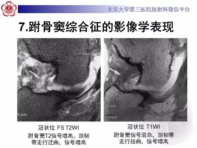 【病例】跗骨窦综合征1例MR影像诊断