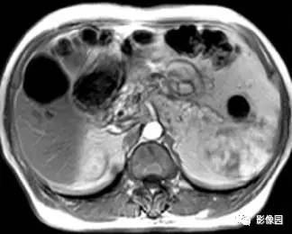 【病例】肝右叶囊肿1例MR 【病例】肝右叶囊肿1例MR