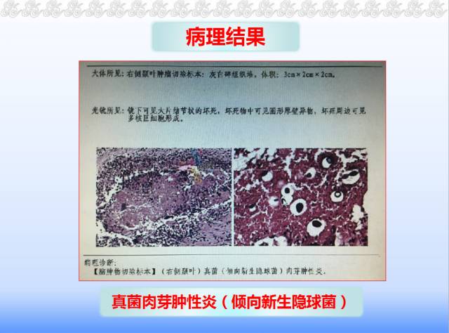 【病例】脑隐球菌病1例MR影像表现