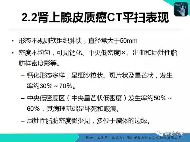 【PPT】肾上腺恶性肿瘤CT诊断