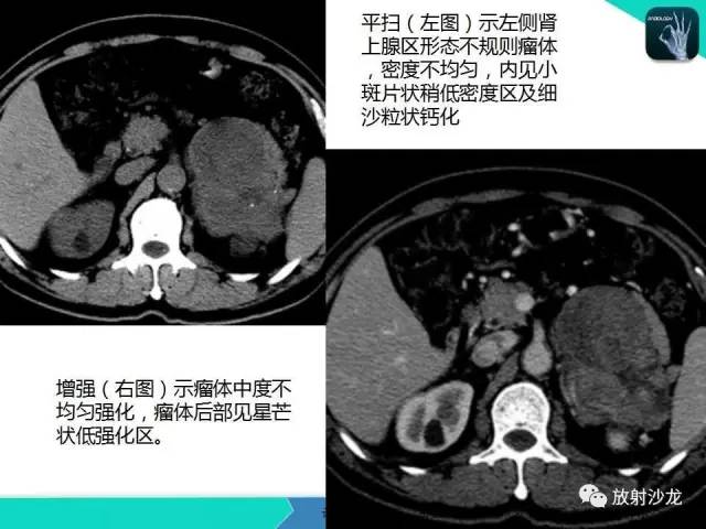 【PPT】肾上腺恶性肿瘤CT诊断