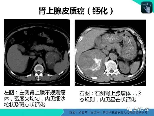 【PPT】肾上腺恶性肿瘤CT诊断