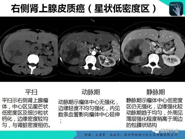 【PPT】肾上腺恶性肿瘤CT诊断