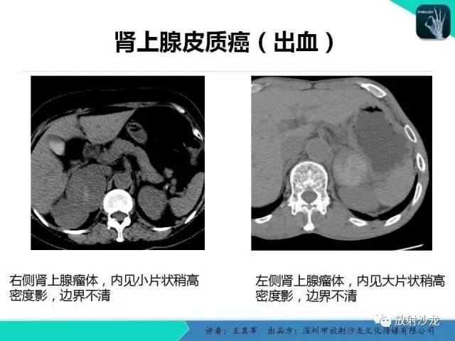 【PPT】肾上腺恶性肿瘤CT诊断