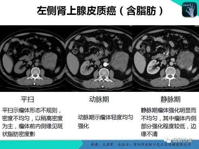 【PPT】肾上腺恶性肿瘤CT诊断