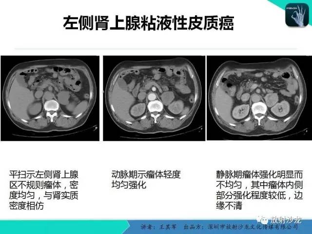 【PPT】肾上腺恶性肿瘤CT诊断