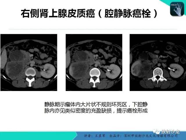 【PPT】肾上腺恶性肿瘤CT诊断