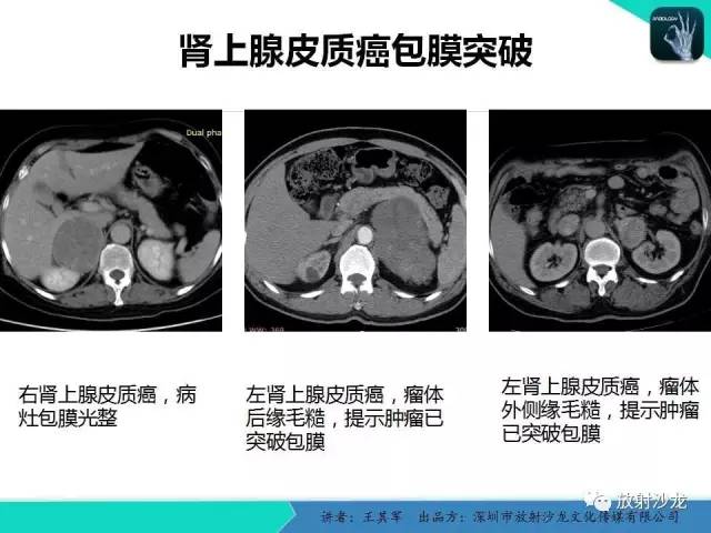 【PPT】肾上腺恶性肿瘤CT诊断