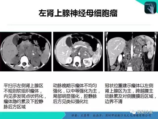 【PPT】肾上腺恶性肿瘤CT诊断