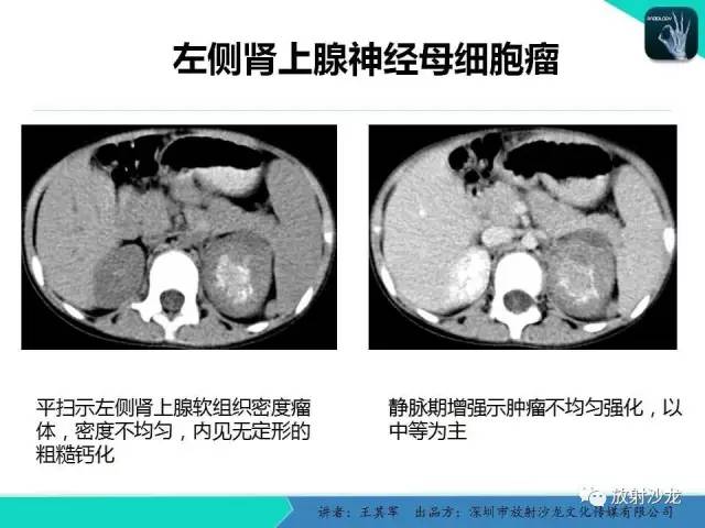 【PPT】肾上腺恶性肿瘤CT诊断