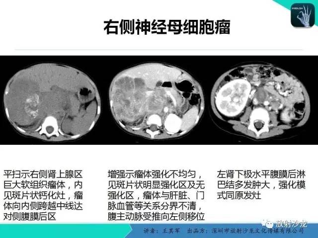 【PPT】肾上腺恶性肿瘤CT诊断