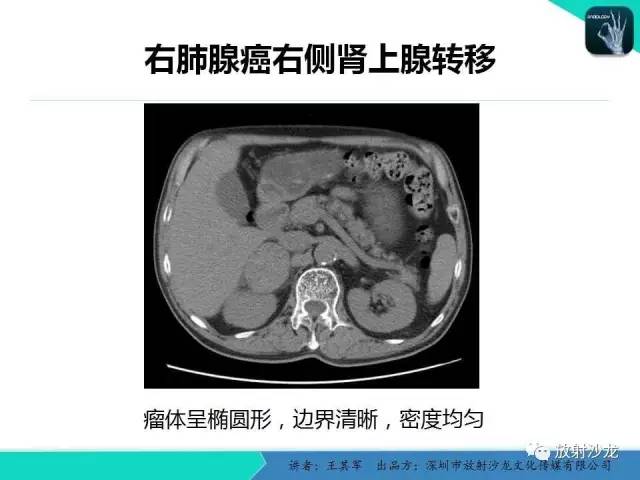 【PPT】肾上腺恶性肿瘤CT诊断
