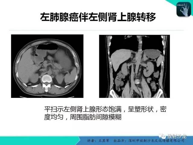 【PPT】肾上腺恶性肿瘤CT诊断