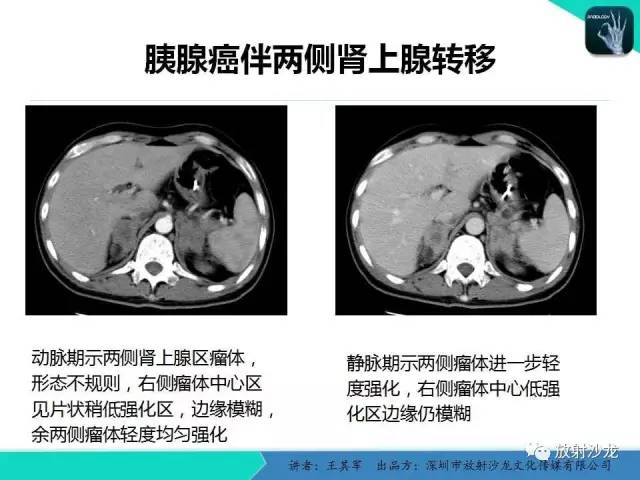 【PPT】肾上腺恶性肿瘤CT诊断