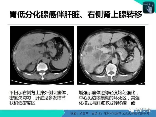 【PPT】肾上腺恶性肿瘤CT诊断