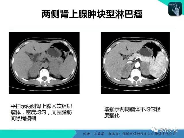 【PPT】肾上腺恶性肿瘤CT诊断