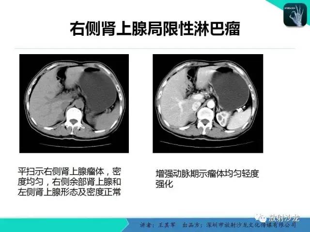 【PPT】肾上腺恶性肿瘤CT诊断