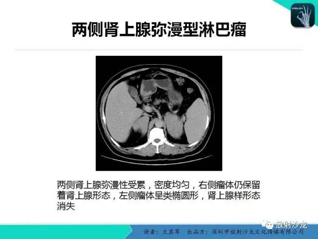 【PPT】肾上腺恶性肿瘤CT诊断
