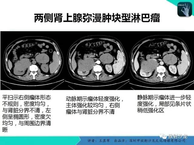 【PPT】肾上腺恶性肿瘤CT诊断